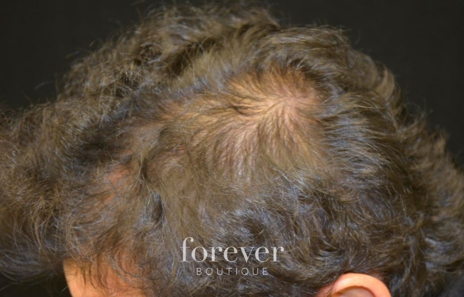 PRP Cheveux & Traitement Plasma | Forever Institut