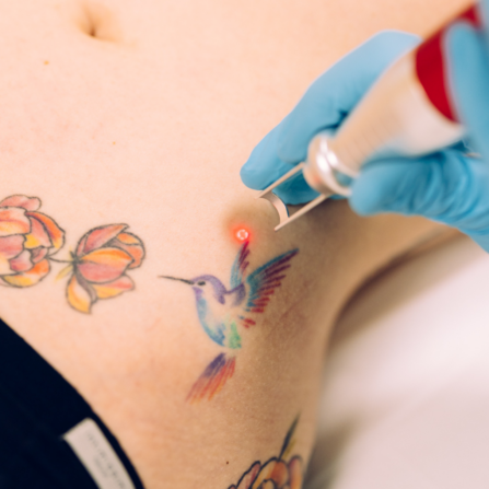 effacer tatouage laser Suisse