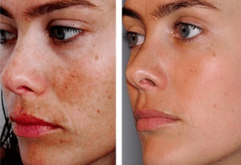 Traitements Contre l’acné | Forever Institut